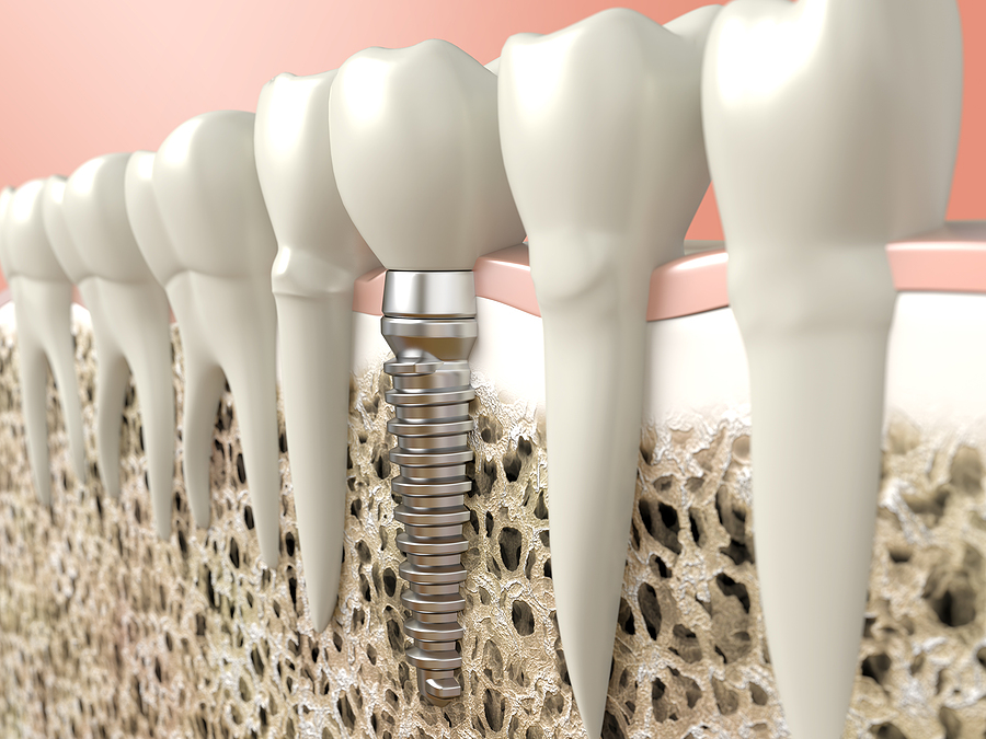 Transform Your Smile with Dental Implants in St. George, UT