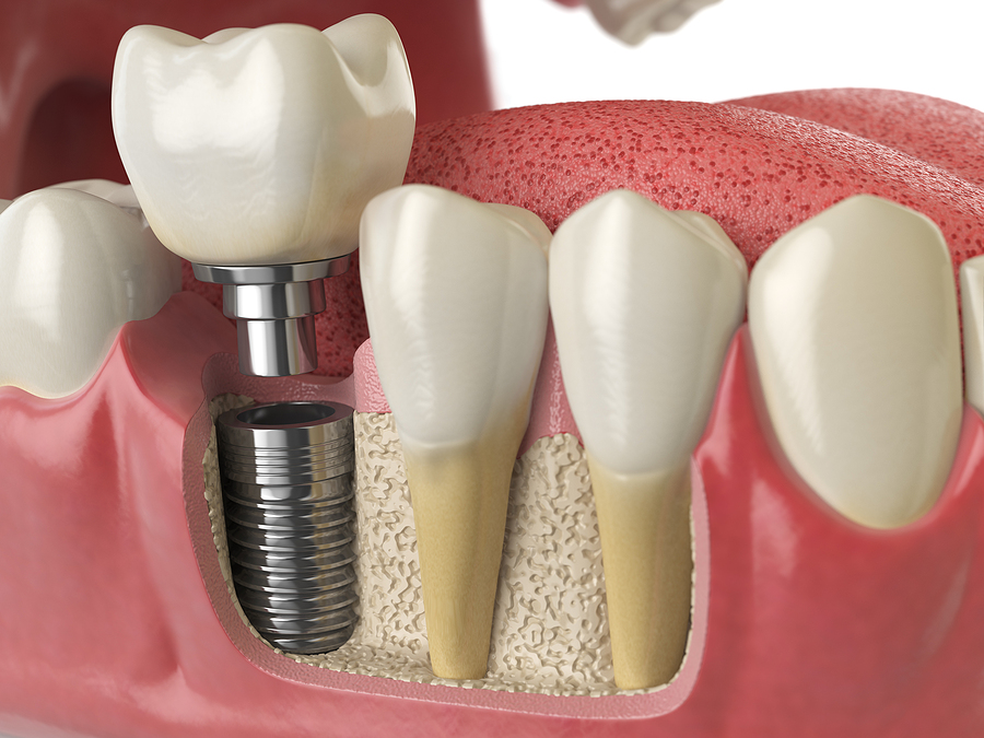 Restore Your Smile with Dental Implants in George, UT