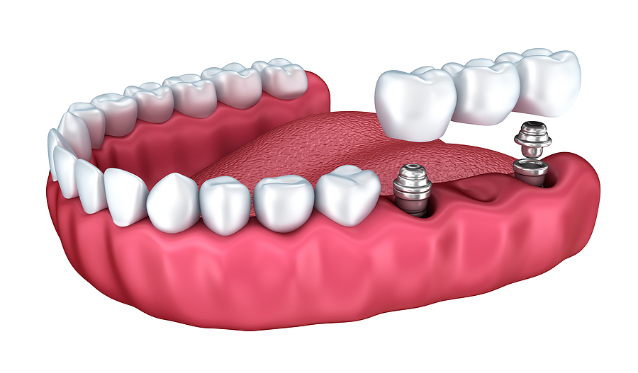 Restoring Smiles with Confidence: The Modern Solution of Dental Implants