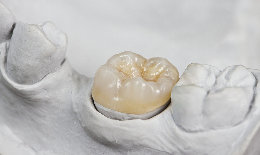 Precision Restorations with Inlay & Onlays in St. George, UT