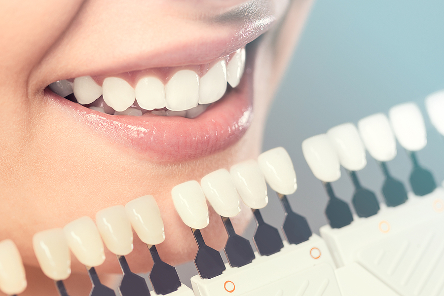 The Ultimate Guide to Porcelain Crowns in St. George, UT