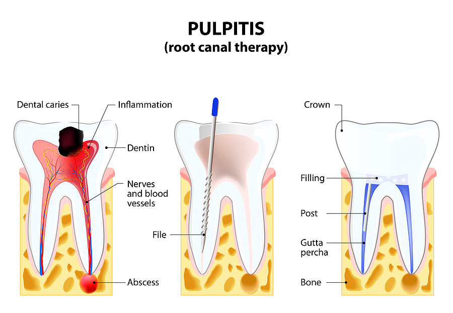 Understanding Root Canals in George, UT: A Complete Guide