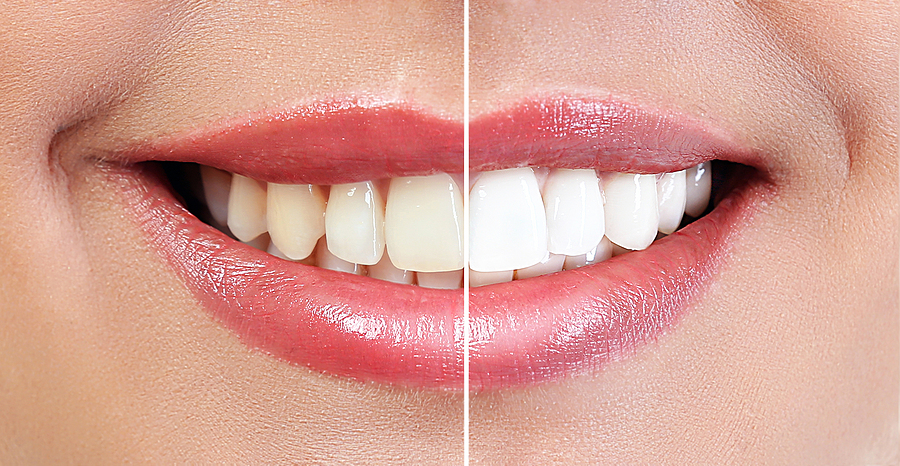 Brighten Your Smile: A Complete Guide to Teeth Whitening in George, UT