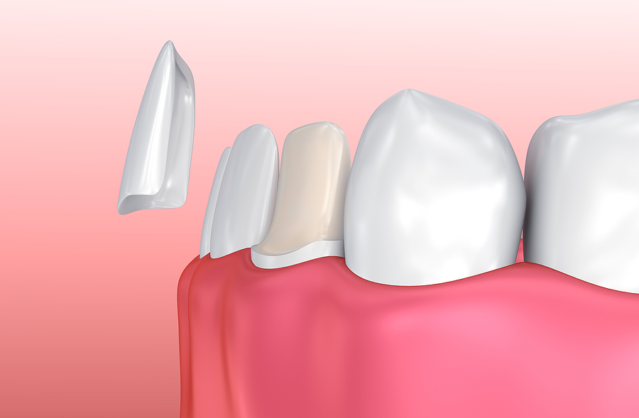 Transforming Smiles with Veneers: A Guide to Achieving Your Dream Smile
